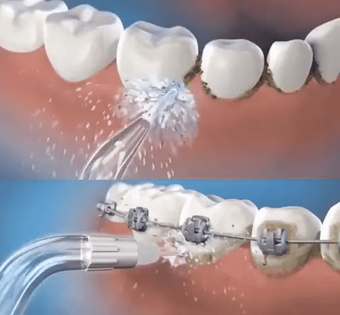 AquaDent™ - Transforma tu sonrisa en casa🦷